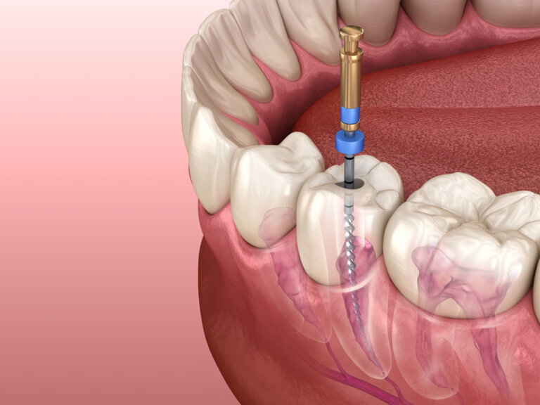 can-a-root-canal-be-done-more-than-once-on-the-same-tooth