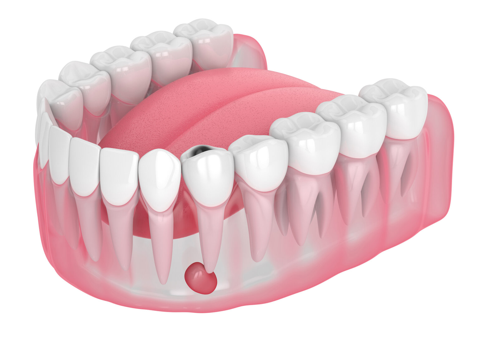 what-happens-if-you-leave-an-abscessed-tooth-untreated