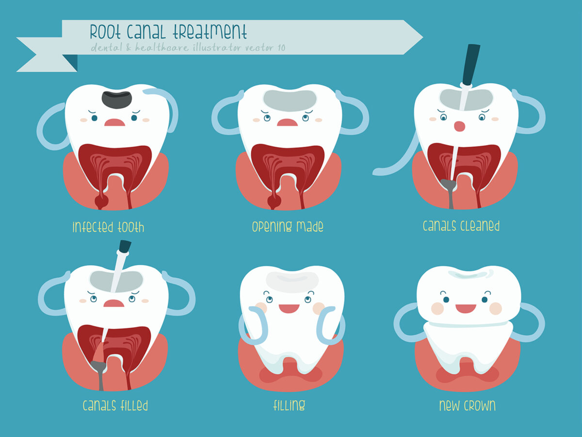 can-root-canal-heal-itself