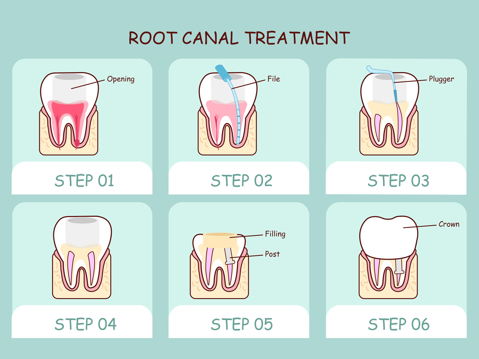 Does A Big Cavity Mean Root Canal 