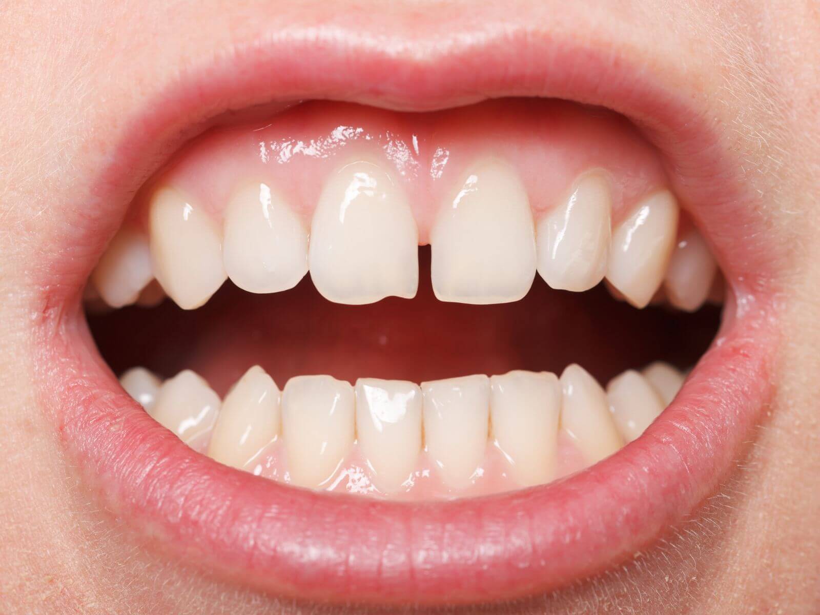 Treatment Options To Close A Gap Between Teeth