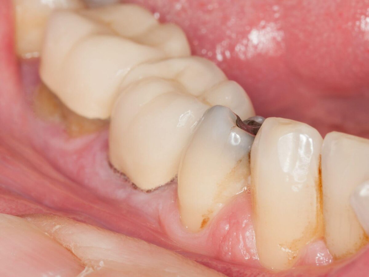 Using A Crown To Restore A Tooth With A Missing Filling