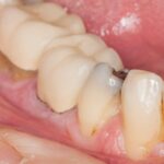 Using A Crown To Restore A Tooth With A Missing Filling